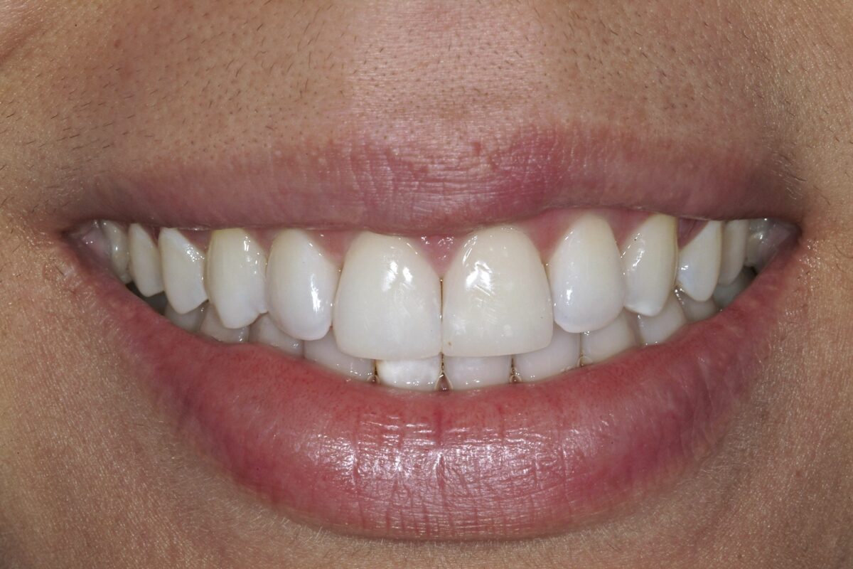 Porcelain Veneers Porcelain Veneers Salem NH