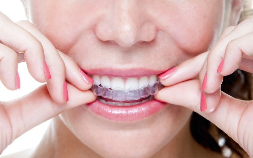 Bite Splint Therapy Bite Splint Therapy