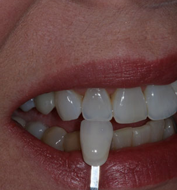 Custom Teeth Shade Blending Custom Teeth Shade Blending