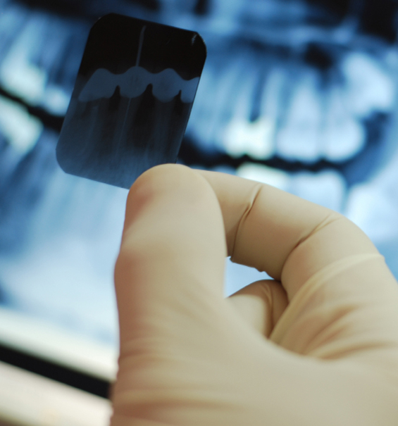 Digital Dental X-Rays Digital Dental X-Rays