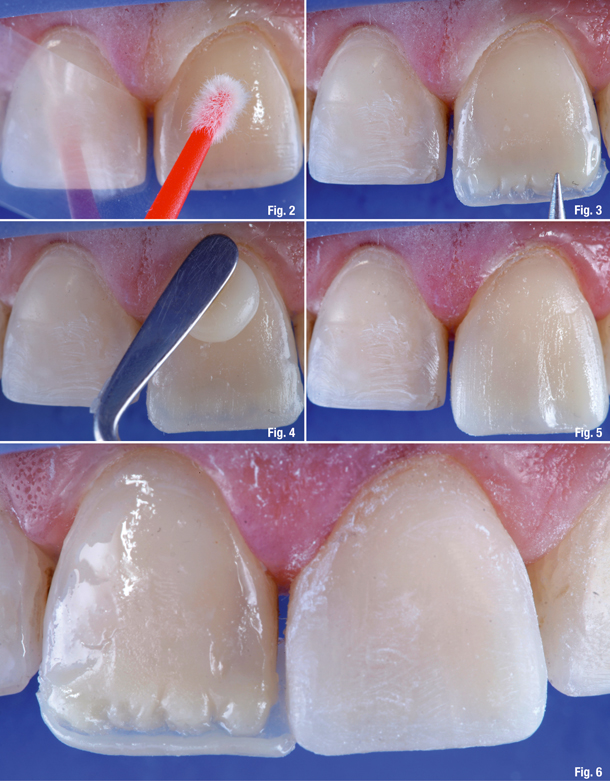 Artistic Direct Composite Veneers Artistic Direct Composite Veneers